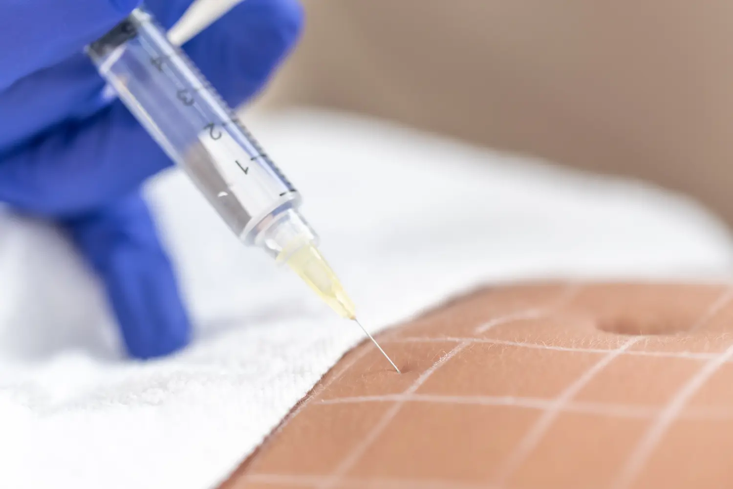 Anti -Cellulite -Injektion