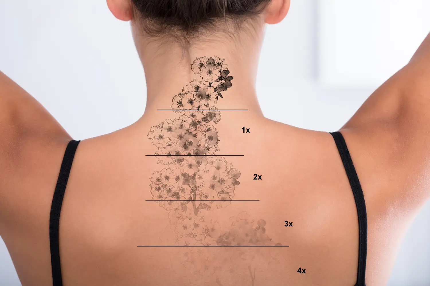 Tattooentfernung am Rücken einer Frau
